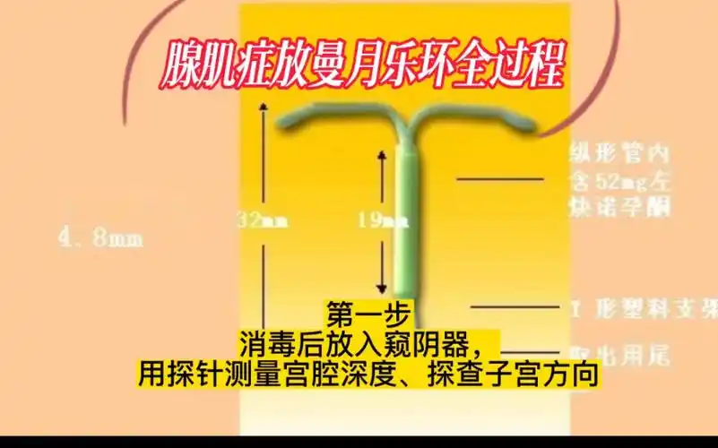 子宫腺肌症放置曼月乐环过程
