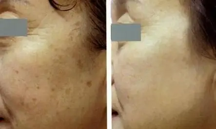 要想了解老年斑扁平疣的区别,首先要知道什么是老年斑