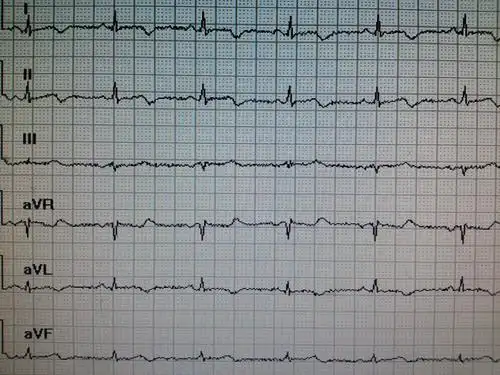 冠状t一例 - 心电图脑电图专业讨论版 - 爱爱医医学论坛