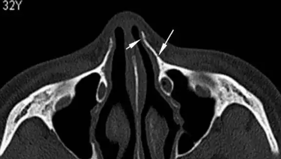 鼻骨横断位重组图像示左侧上颌骨额突骨折(长白箭头),无明显错位及