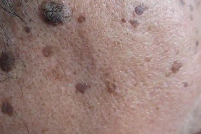 扁平疣与老年斑的区别图片