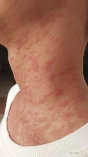 玫瑰糠疹? - 皮肤及性传播疾病讨论版 - 爱爱医医学论坛