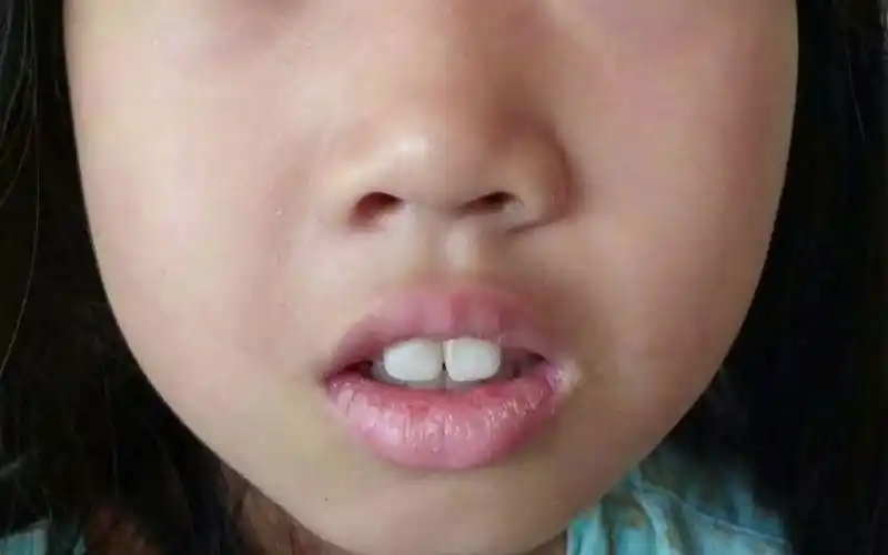 女孩形成了腺样体面容