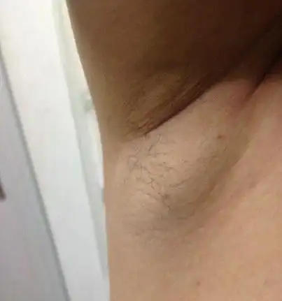 腋下发现有肿块是淋巴结肿大还是乳腺增生3招可判别