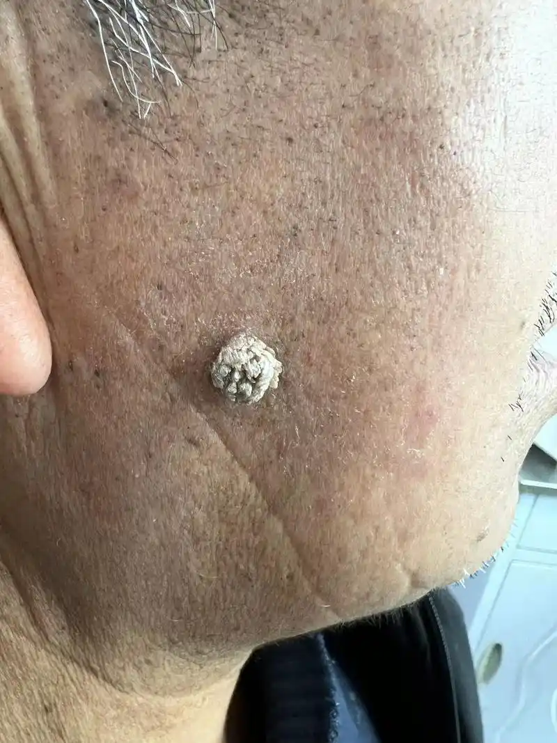 疣类疾病之寻常疣