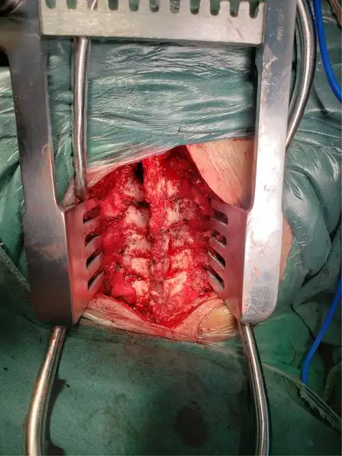 颈后路椎管扩大成形术治疗脊髓型颈椎病