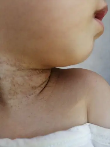 宝宝脖子总是湿汗,长了一些白色小疙瘩,里面能挤出白色的东西,小疙瘩