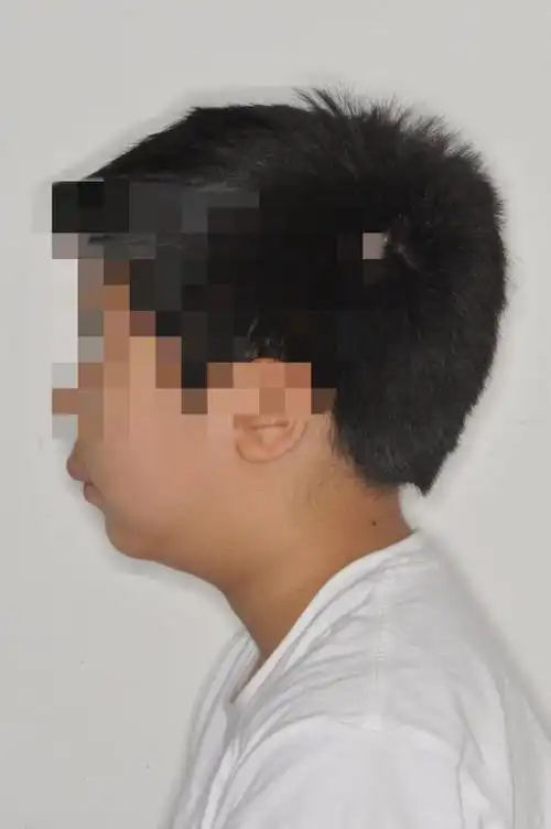 其实这种描述,通常可以判断为腺样体肥大面容.