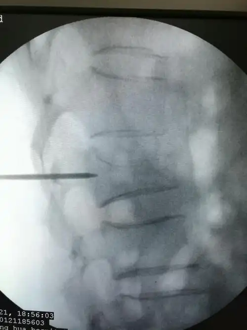 腰1椎体压缩性骨折(3度)