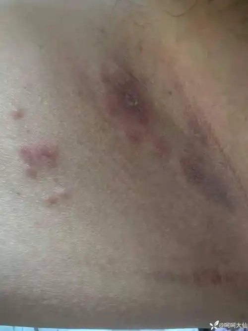 求助双侧腹股沟红斑一周由皮疹进展为红斑瘙痒部分中央色素沉着伴皮损