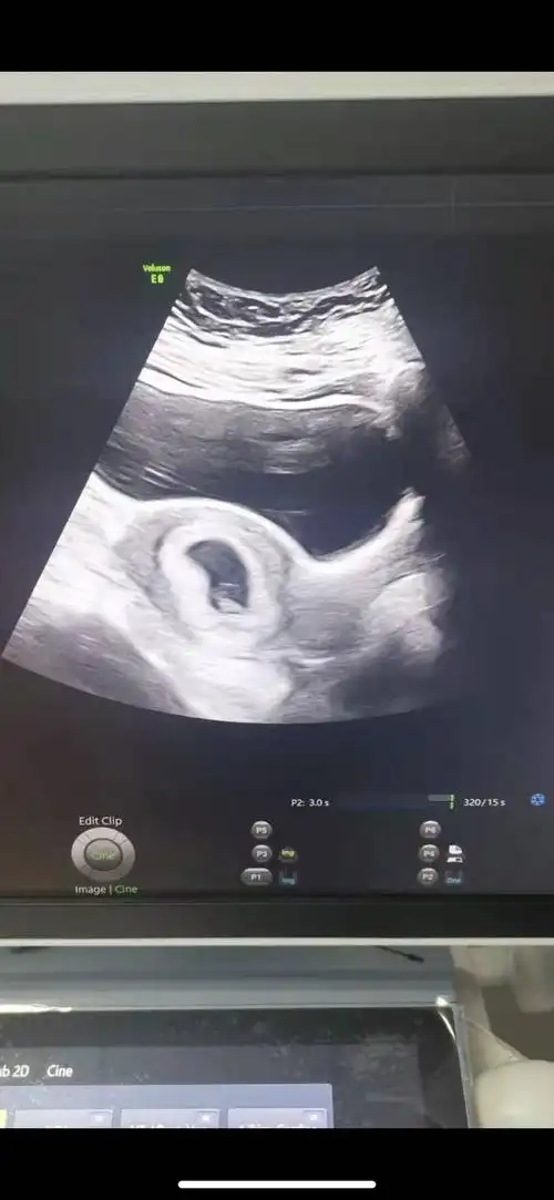 听说看孕囊形状能看出男女?