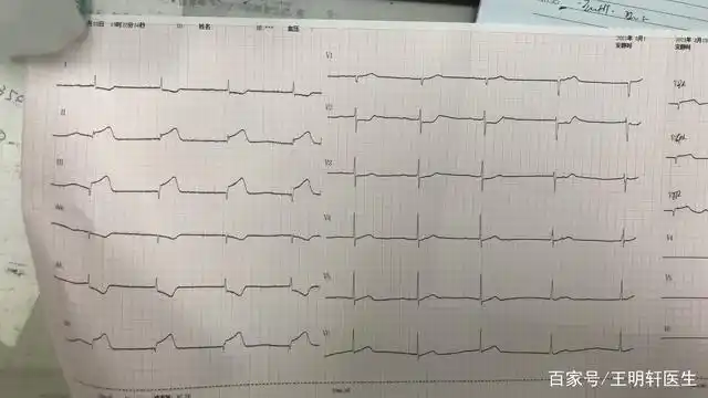 急性心肌梗死也是可以预防的