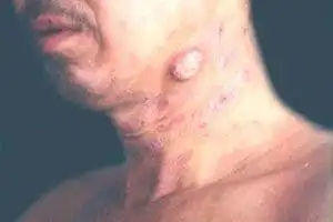 蕈样肉芽肿应怎么治疗