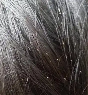 孩子得了头虱怎么办