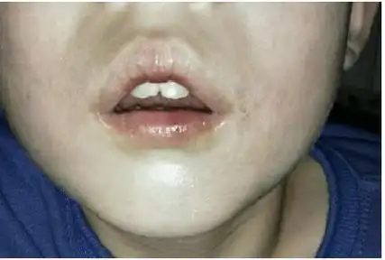 小儿腺样体面容什么样?不要等到出现腺样体面容才就诊