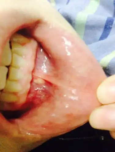 口腔 嘴里面长了个东西 摸起来像一团肉 不知道是什么 请专家解答