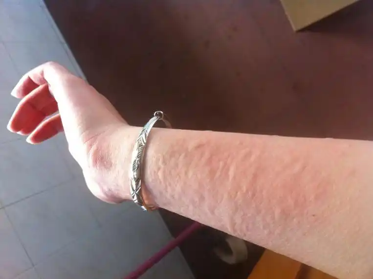 风团荨麻疹症状图片