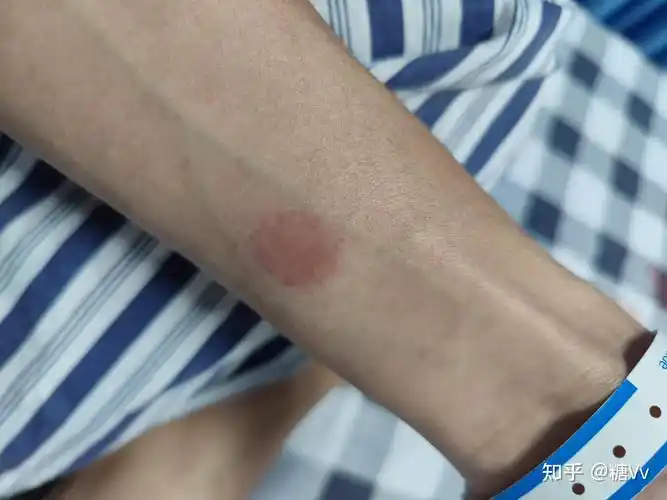 2023年确诊肺结核全记录