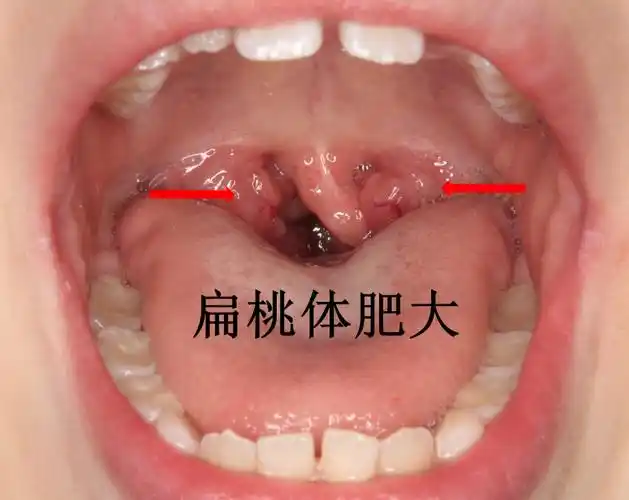 家长需警惕腺样体肥大!