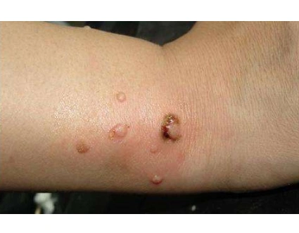 六盘水疣专家_六盘水治疗疣哪个专家好_六盘水治疗疣最好的专家/排行