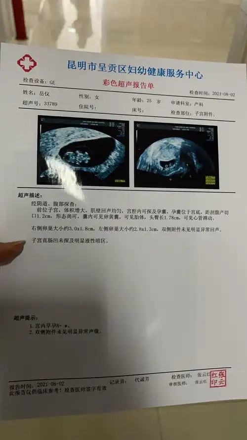 都说茄子孕囊是男孩,宝妈们是不是这样呀
