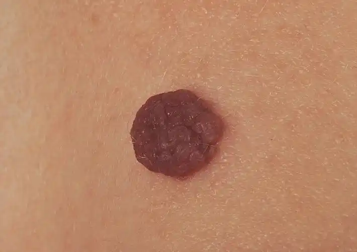 34岁女子感染hpv坚持每天跑5公里现在怎么样了不妨来看一下