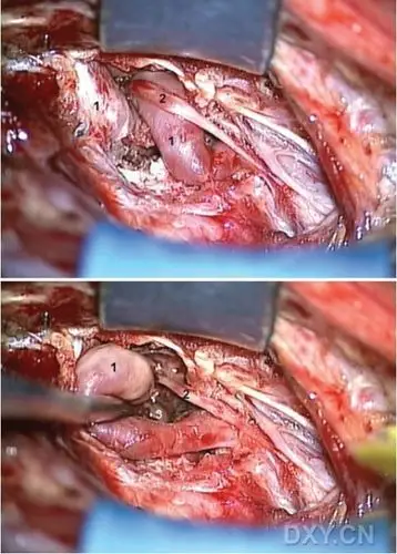 椎动脉冗长环导致神经根型颈椎病手术治疗1例报道 - 丁香园