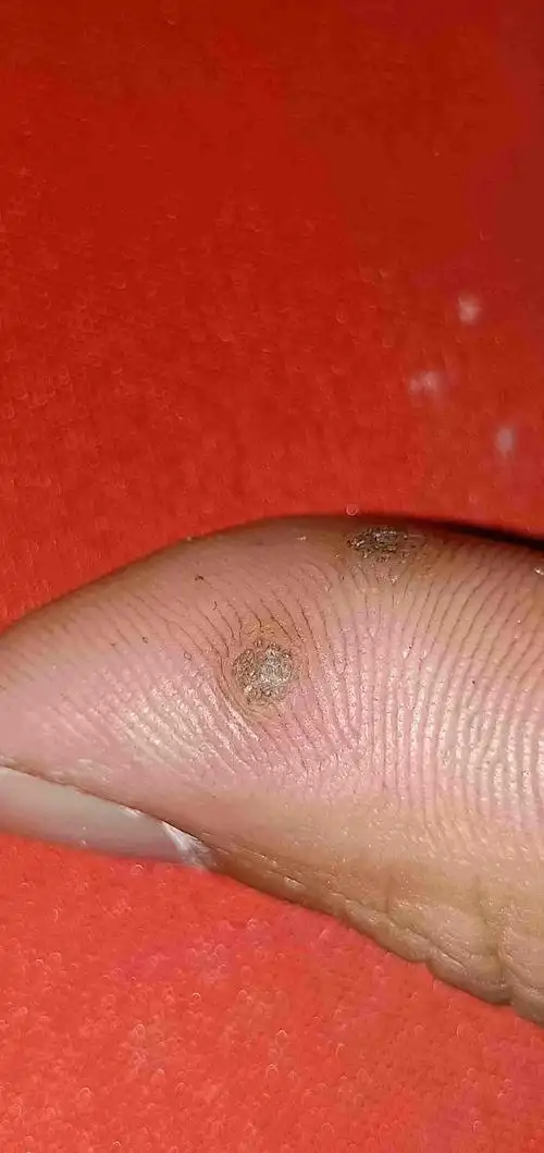 手上长疣,怎么根除,不用激光,冷冻有没有其他办法?