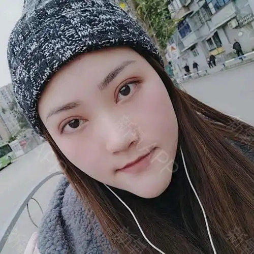 【睑缘切开双眼皮术后第30天】一个月啦,要发个照片_圈子-新氧美容