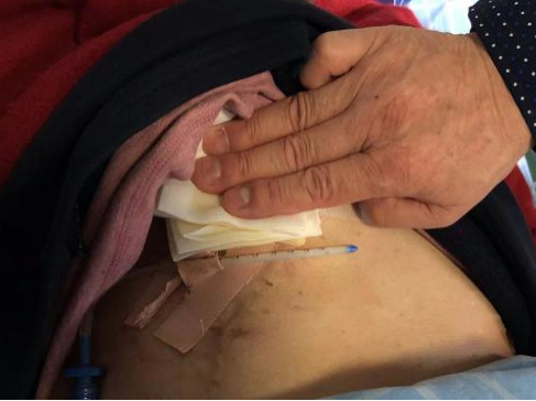 检查后胸腔引流管意外滑脱处理方法来了