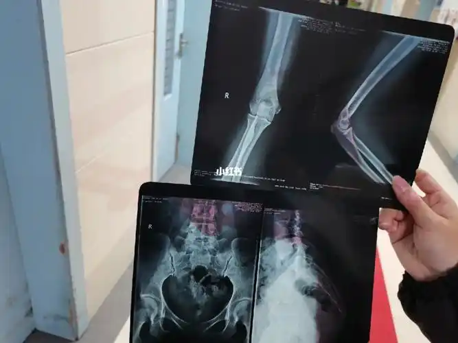 报警以后 去交警大队鉴定是肇事者全责 医院拍了片子是尾骨滑脱 他说