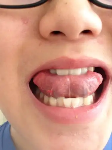 舌头下面有不明物体.像是上火.怎么办