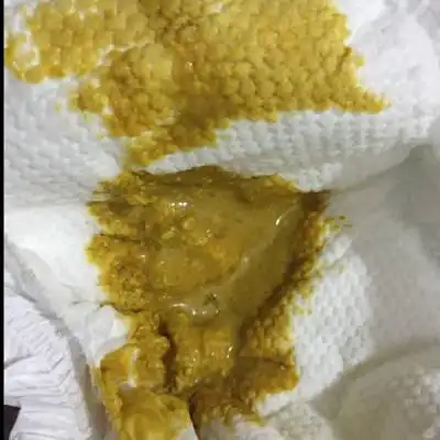 宝宝刚出生九天,今天拉稀,拉了三次.肚子可以听见咕噜咕噜的声音.现在