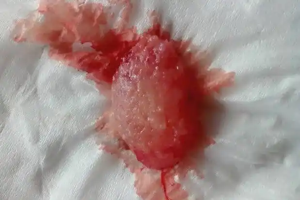 50天自然流产掉下的孕囊图片