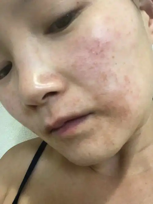 日光性皮炎日晒伤晒斑