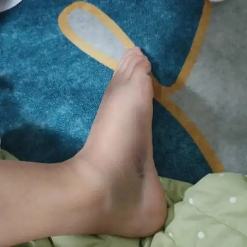 昨天是一个值得纪念的日子 崴脚骨折 第一次拄起了拐杖  开始躺尸的