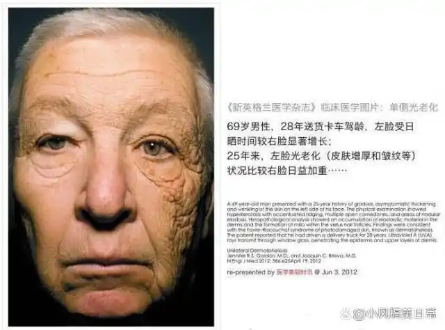 uva有很轻的穿透力,可以直接到达皮肤真皮层,破坏弹性和胶原纤维,晒黑