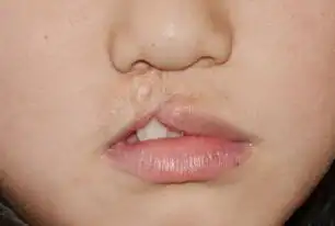 痛在娘心的唇腭裂如何预防比较好