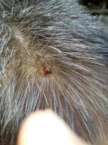 18 2014-08-25 09:29 医师来自江苏省射阳县人民医院 答: 寻常疣