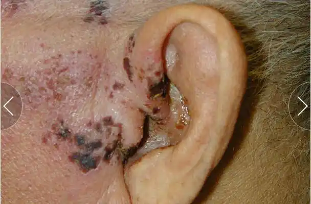 医生必须了解的 9 种病毒性疾病的皮肤黏膜表现