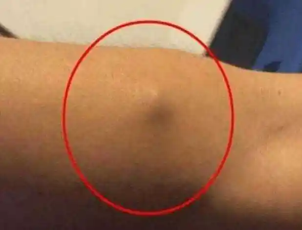 小伙胳膊有个像肿瘤的东西特别的疼,开刀取出来的东西,令人惊讶