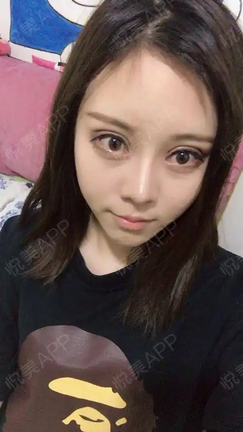 全切双眼皮术后30天_双眼皮术后30天_眼部整形术后30天_悦mer