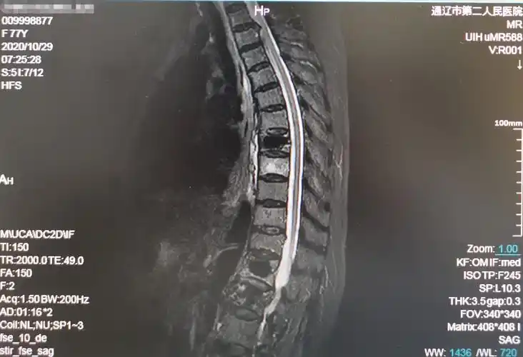 78岁胸椎压缩性骨折患者椎体成型手术一例