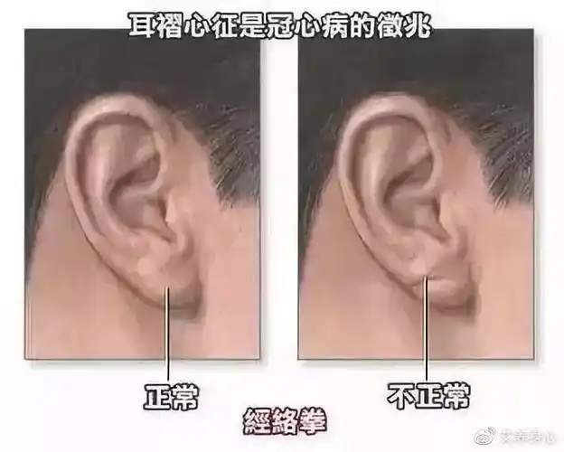 正常人耳垂都是丰满平滑的,但冠心病患者耳垂上往往有一条褶沟,常被称