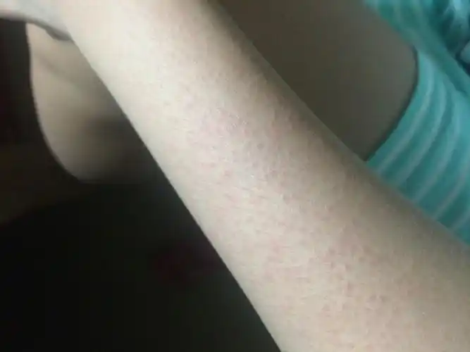 手上起鸡皮疙瘩一样的还痒(手上起鸡皮疙瘩一样的还痒怎么回事)