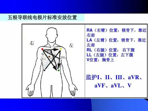 所有分类 医药卫生 心电监护仪的临床应用ppt 五根导联线电极片标准