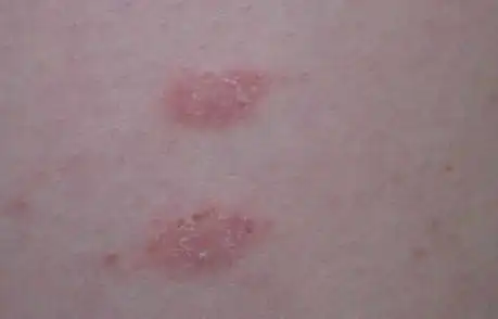 哪些症状有助于我们识别艾滋病