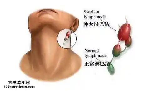 淋巴结肿大怎么办?