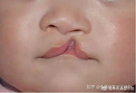 兔唇可以完全治愈吗