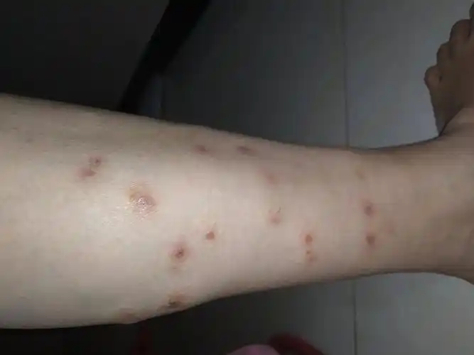 妈妈最近身上长了好多处红疙瘩,奇痒无比,也不疼,受不了抓破后刚开始